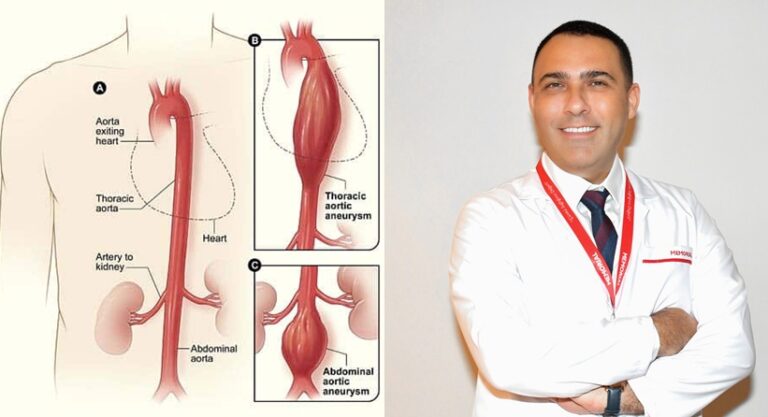 Aort Anevrizması Riskini Azaltan 5 Altın Önlem!