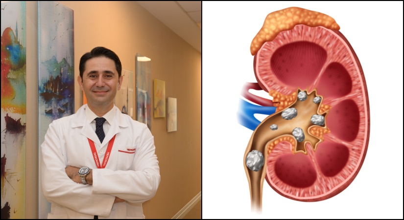 Böbrek Taşından Korunmak İçin 4 Önemli Öneri